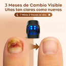 Dispositivo Laser para Hongos en las Uñas 2