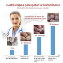 Dispositivo Laser para Hongos en las Uñas 3